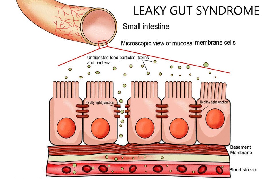 leaky-gut-syndrome-diagram